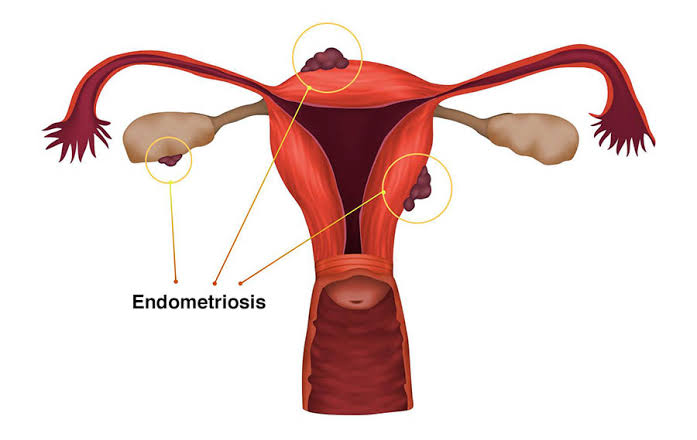 ENDOMETRIOSIS DIAGNOSIS: WHAT TO EXPECT AT YOUR APPOINTMENT