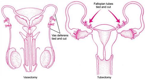 TOP FACTS ABOUT SURGICAL CONTRACEPTION OPTIONS