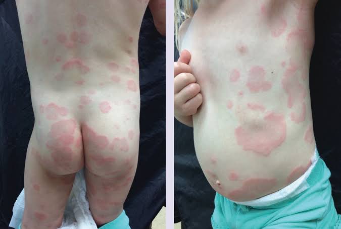 EXPERT TIPS FOR MANAGING REACTIVE ERYTHEMAS