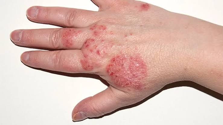 NON-INFECTIVE DERMATOSES: EASY GUIDE TO ECZEMA