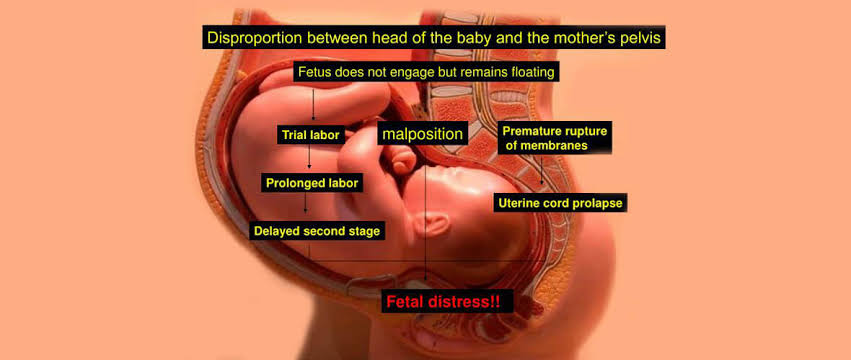 CONTRACTED PELVIS AND CEPHALOPELVIC DISPROPORTION
