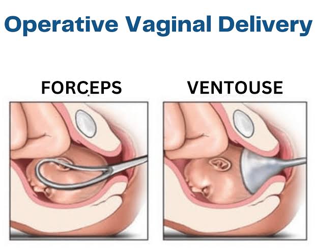 INSTRUMENTAL DELIVERY IN MODERN OBSTETRICS