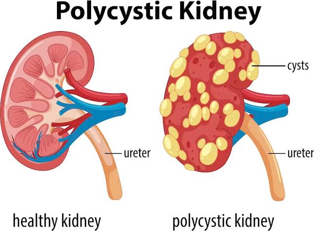 GENETIC FACTORS AND RISK ASSESSMENT IN AUTOSOMAL DOMINANT POLYCYSTIC KIDNEY DISEASE