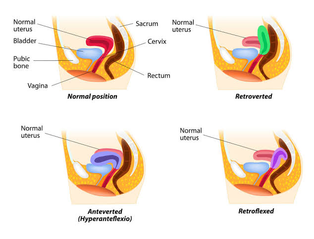 RETROVERTED FLEXION OF THE UTERUS