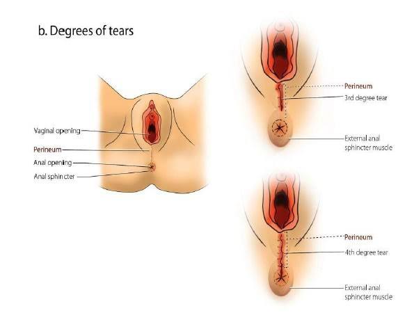 GENITAL TRACT INJURY DURING LABOR