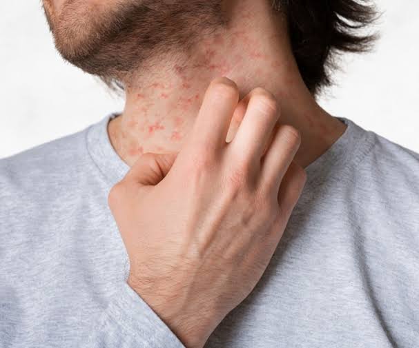 VASCULITIS AND ITS IMPACT ON YOUR HEALTH