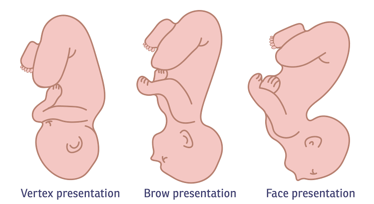 FACE AND BROW PRESENTATION