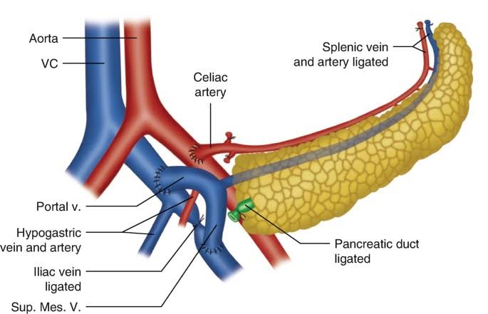 EXPLORING CUTTING-EDGE SURGICAL PROCEDURES FOR PANCREAS RECOVERY