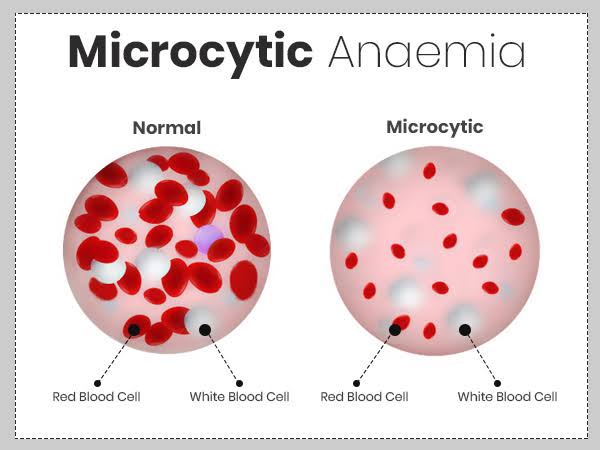 MICROCYTIC ANEMIA