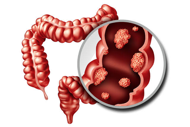 COMMON SIGNS OF COLON AND RECTAL TUMORS YOU SHOULD KNOW
