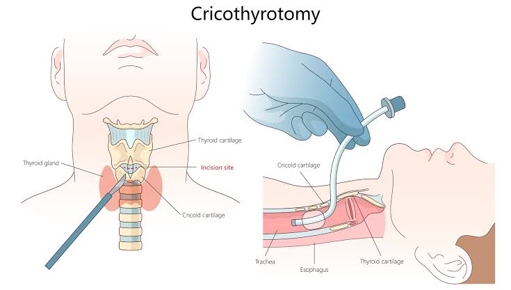 THE GUIDEWIRE TECHNIQUE FOR EMERGENCY CRICOTHYROTOMY