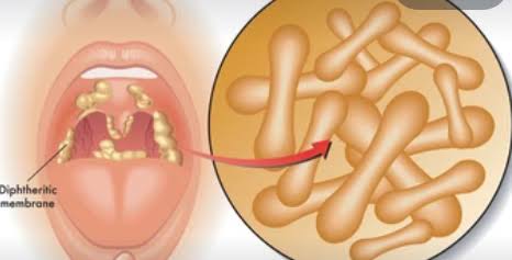 LEARN ABOUT DIPHTHERIA: HOW IT SPREADS AND PREVENTIVE MEASURES