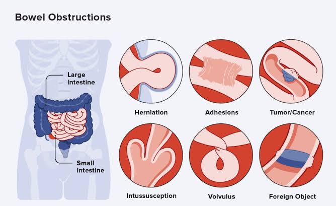 HOW’S INTESTINAL OBSTRUCTION DIAGNOSED: A CLEAR GUIDE