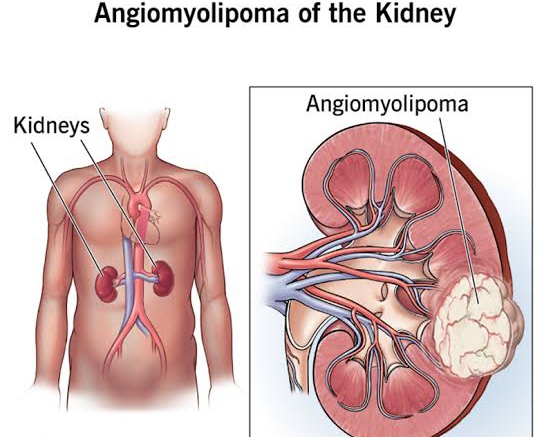 RENAL TUMORS: PATHOLOGY OF URETER AND URINARY BLADDER