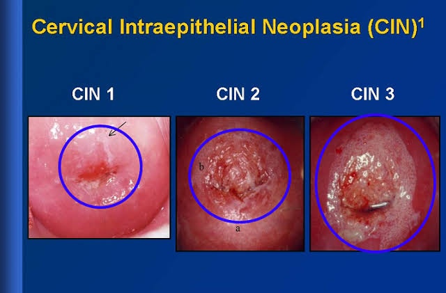 DISEASES OF THE CERVIX