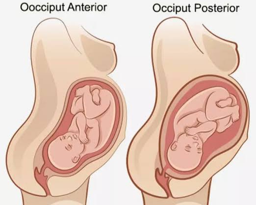 OCCIPITO-POSTERIOR POSITION