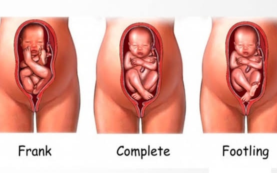 BREECH PRESENTATION: TIPS FOR EXPECTING PARENTS