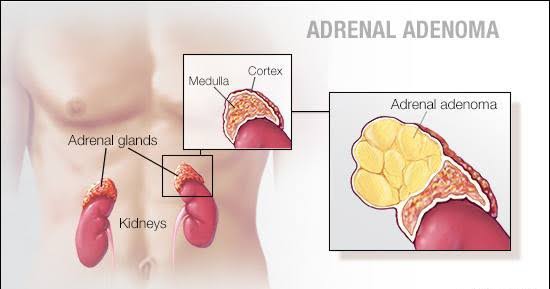 PATHOLOGY OF THE ADRENAL GLANDS