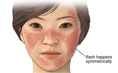 SYSTEMIC LUPUS ERYTHEMATOSUS EXPLAINED
