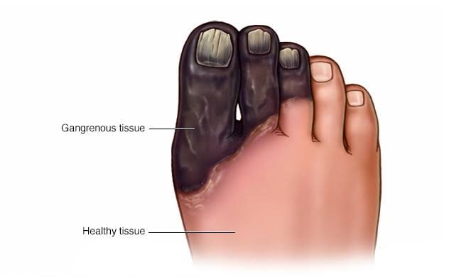 HOW GANGRENE CAN LEAD TO AMPUTATION EXPLAINED