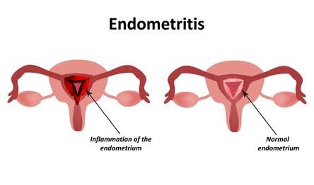 ENDOMETRITIS: INSIGHTS INTO ITS ETIOLOGY AND PATHOGENETIC PROCESSES
