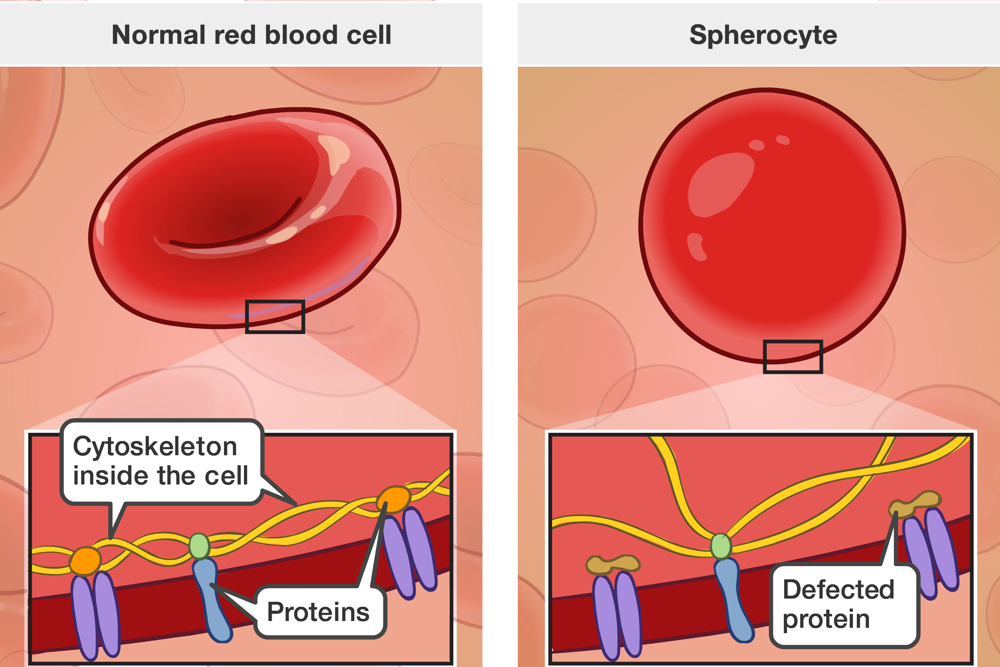 EFFECTIVE DIAGNOSTIC APPROACHES FOR HEREDITARY SPHEROCYTOSIS AND G6PD DEFICIENCY