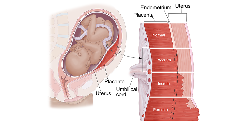 COMPREHENSIVE INSIGHTS INTO PLACENTA ACCRETA SPECTRUM: SYMPTOMS, RISKS, AND SOLUTIONS