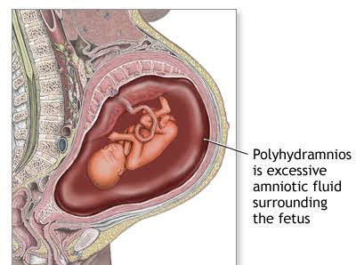 COMPREHENSIVE GUIDE TO POLYHYDRAMNIOS: FROM SYMPTOMS TO TREATMENT OPTIONS