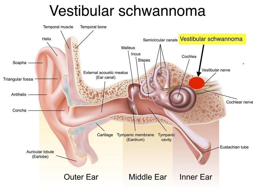 CLINICAL PRESENTATION OF VESTIBULAR SCHWANNOMA: A DETAILED OVERVIEW