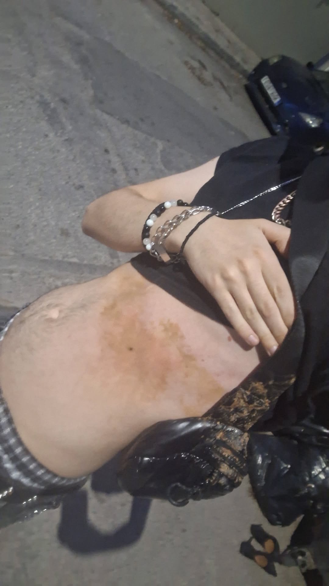 Ομοφοβικός ξυλοδαρμός στην Ανούπολη