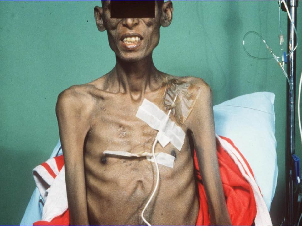 CANCER CACHEXIA EXPLAINED: KEY INSIGHTS INTO PATHOPHYSIOLOGY AND MANAGEMENT