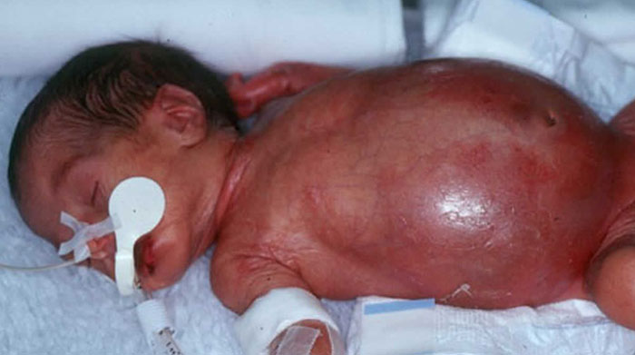 NECROTIZING ENTEROCOLITIS: INSIGHTS INTO ETIOLOGY, DIAGNOSIS TECHNIQUES, AND TREATMENT OPTIONS