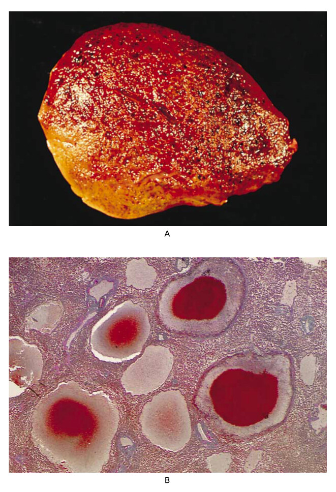 PELIOSIS HEPATIS: UNRAVELING A RARE AND CHALLENGING LIVER CONDITION