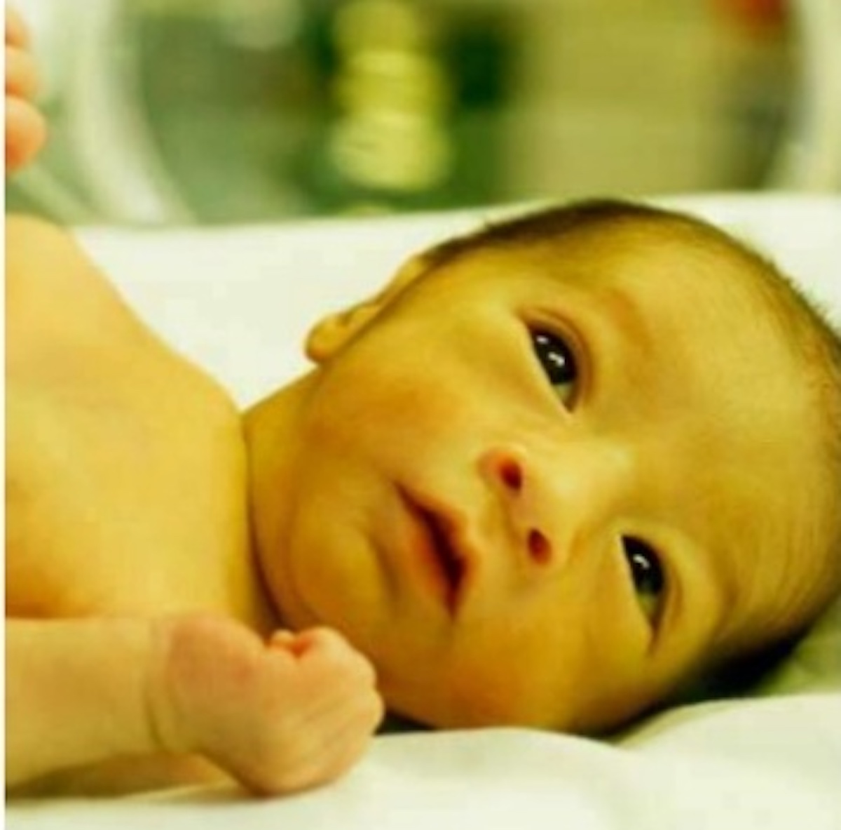 UNDERSTANDING NEONATAL CHOLESTASIS: A CLINICAL OVERVIEW