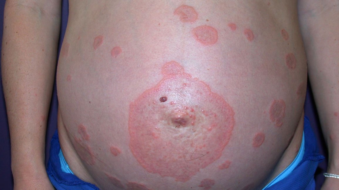 PEMPHIGOID GESTATIONIS EXPLAINED: A DEEP DIVE INTO THIS PREGNANCY-SPECIFIC SKIN CONDITION