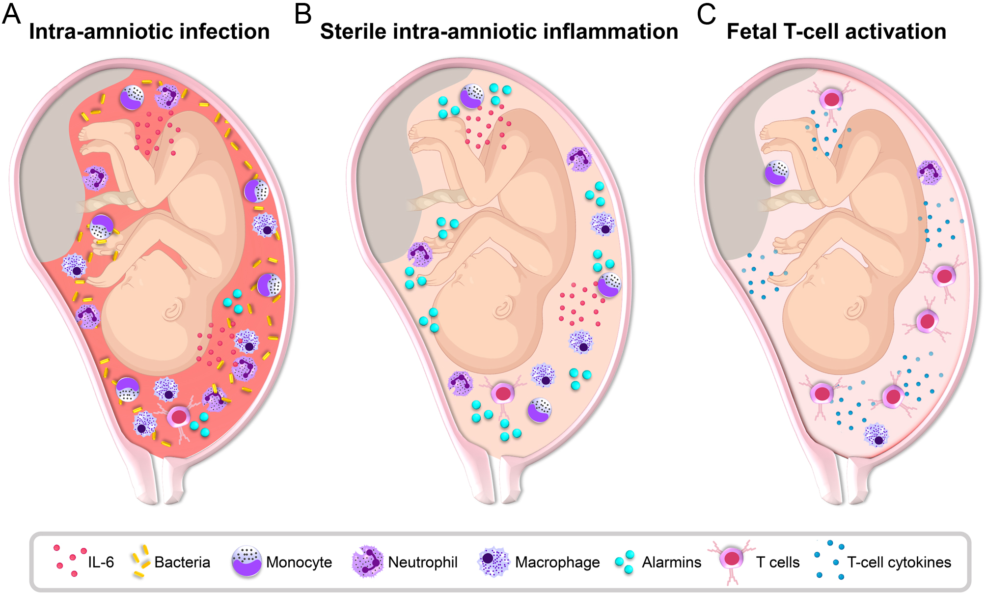 COMPLETE OVERVIEW OF INTRAAMNIOTIC INFECTION: FROM DIAGNOSIS TO TREATMENT
