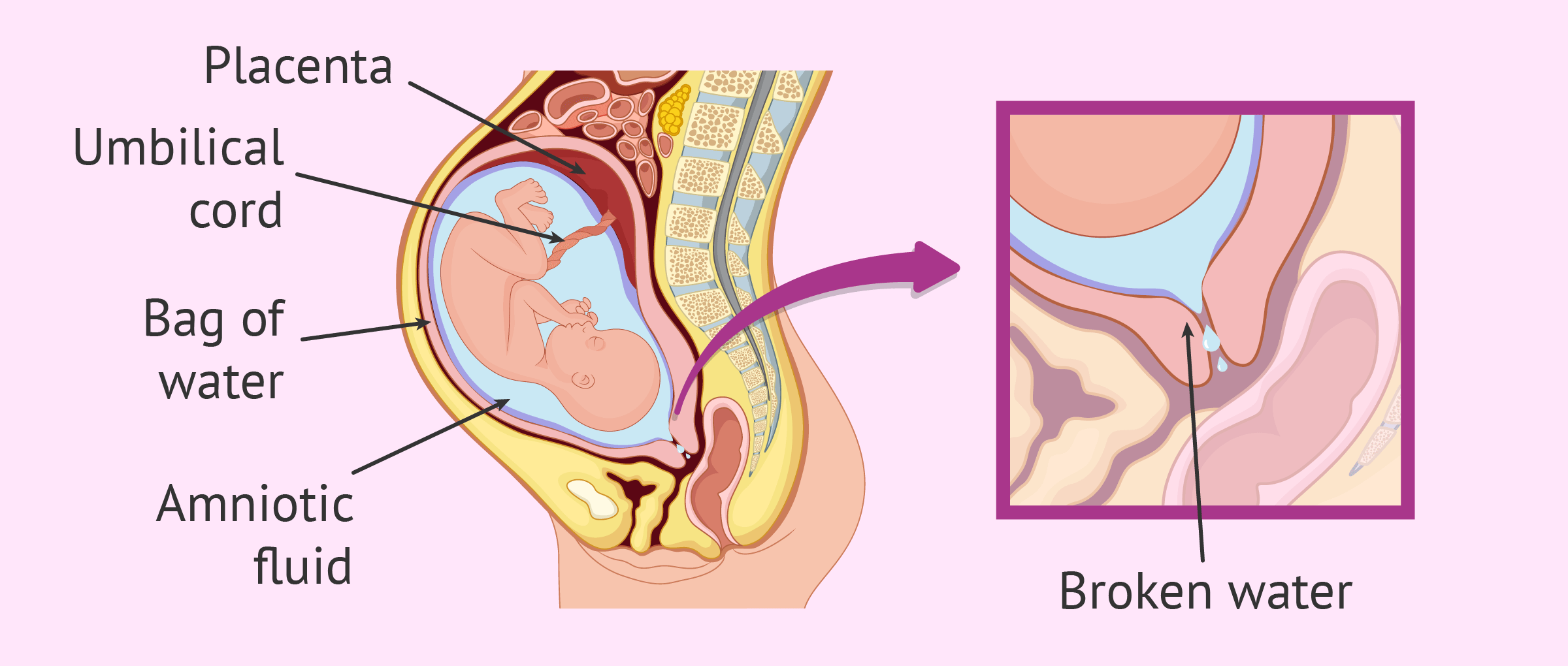 PREMATURE RUPTURE OF MEMBRANES IN PREGNANCY: WHAT EXPECTING MOTHERS NEED TO KNOW