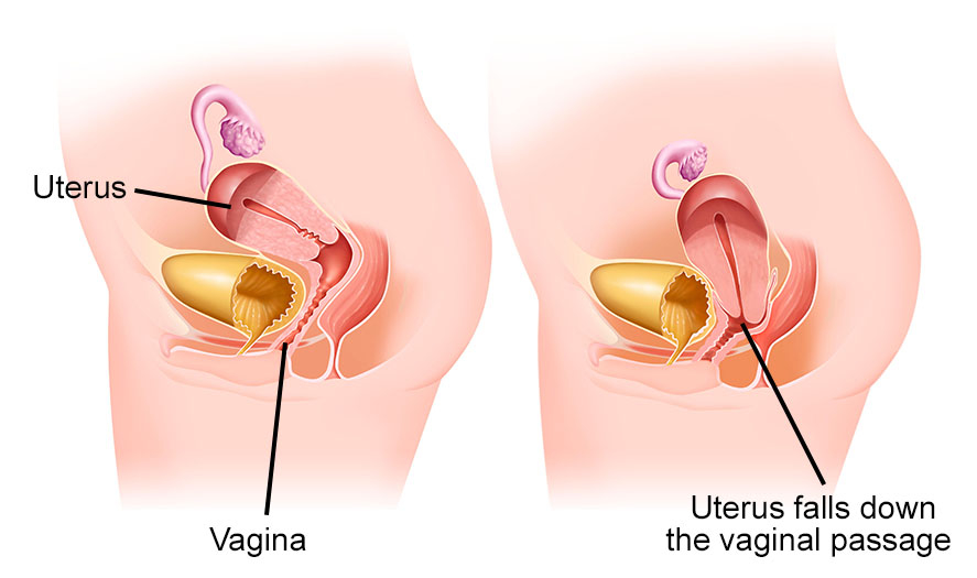 GENITAL PROLAPSE: SIGNS YOU SHOULDN’T IGNORE