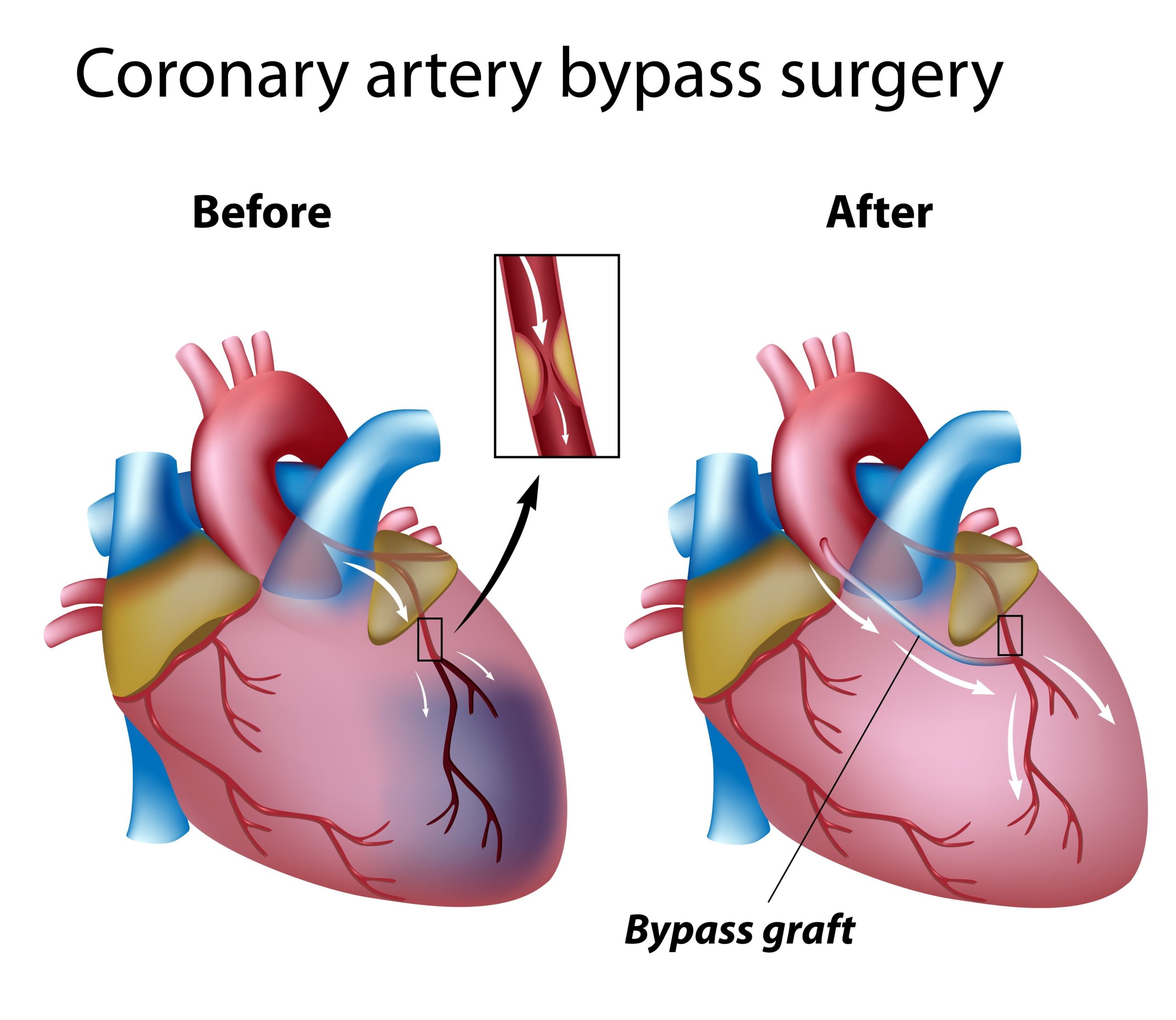 WHAT YOU NEED TO KNOW ABOUT CORONARY ARTERY BYPASS GRAFTING PROCEDURES