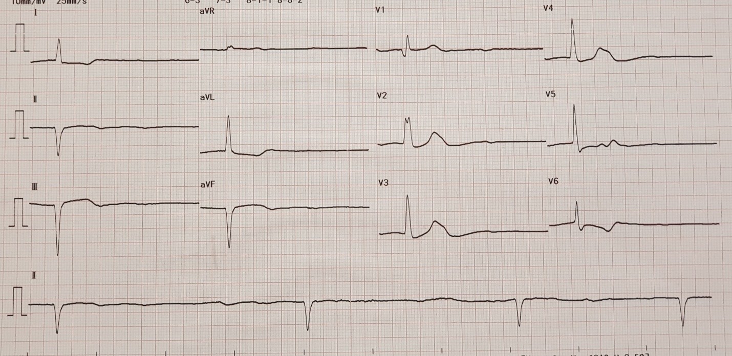 COMPREHENSIVE OVERVIEW OF SICK SINUS SYNDROME: FROM ETIOLOGY TO EFFECTIVE MANAGEMENT