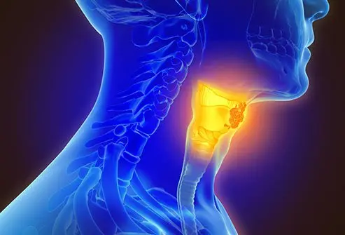 EARLY SIGNS OF LARYNGEAL NEOPLASM YOU SHOULD KNOW