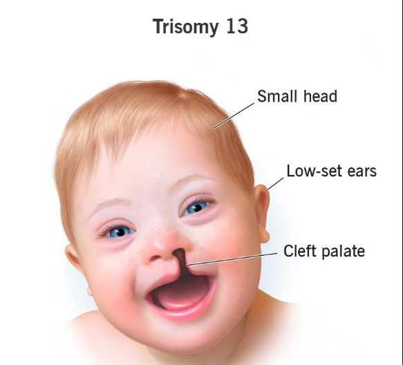 UNDERSTANDING TRISOMY 13: A COMPREHENSIVE GUIDE FOR PARENTS AND CAREGIVERS