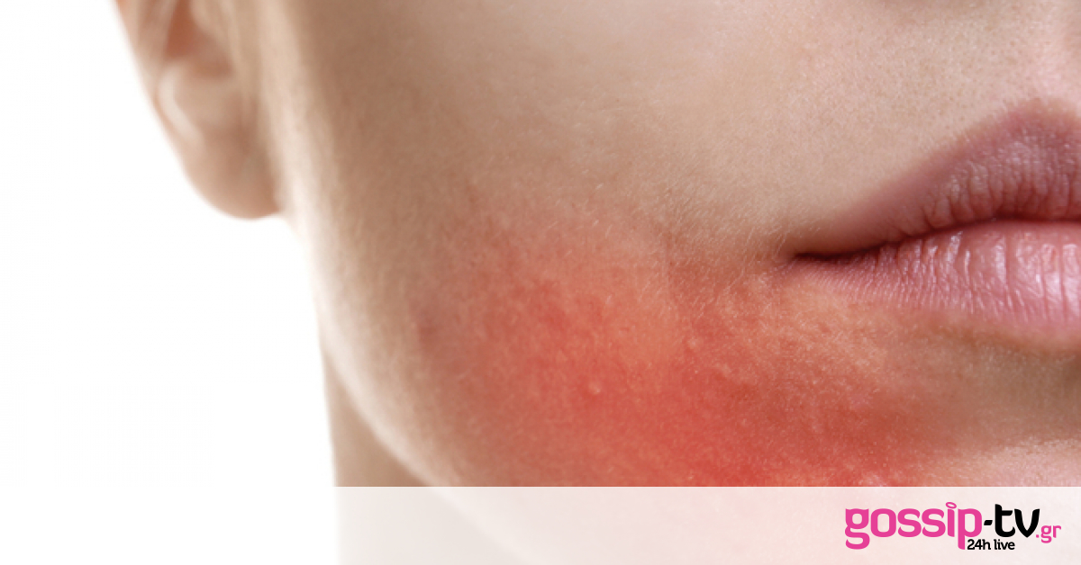 Ορμονοεξαρτώμενη ακμή: Οι 4 τροφές που πρέπει να αποφεύγετε (pics)