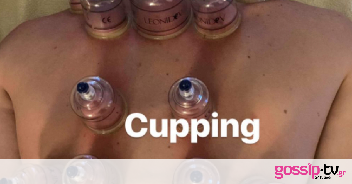 Έλληνας τραγουδιστής έκανε θεραπεία με… βεντούζες!