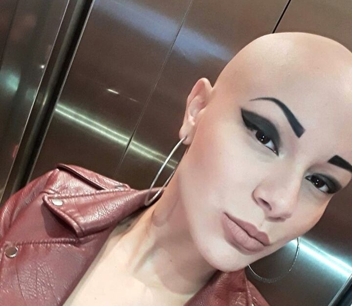 GNTM 2:Οι φωτογραφίες της Λυδίας, που η αλωπεκία δεν την εμποδίζει να είναι πανέμορφη!