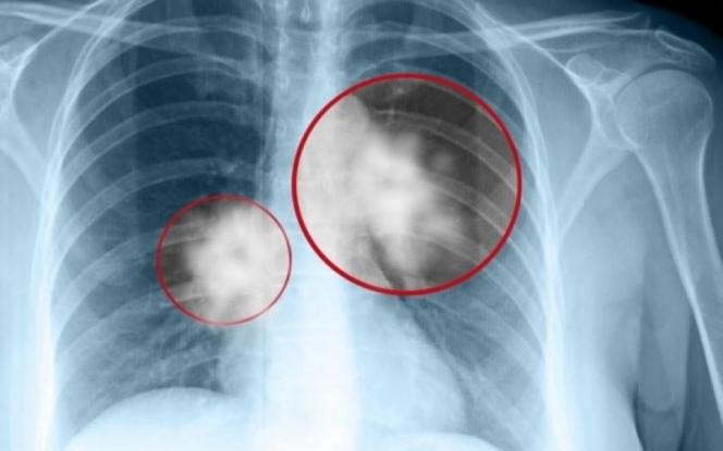 Καρκίνος του πνεύμονα: Ποια δύο επικίνδυνα συμπτώματα δεν πρέπει να αγνοήσετε. Προσοχή
