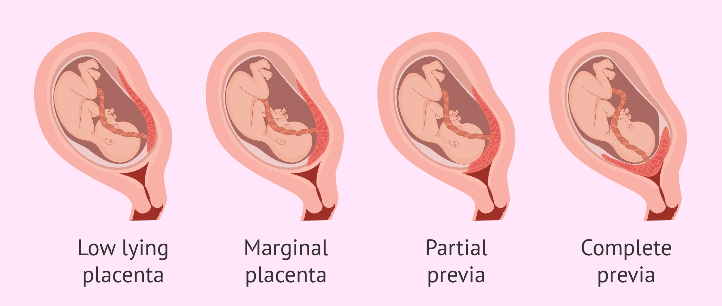 EXPERT INSIGHTS ON PLACENTA PREVIA: DIAGNOSIS AND MANAGEMENT TECHNIQUES