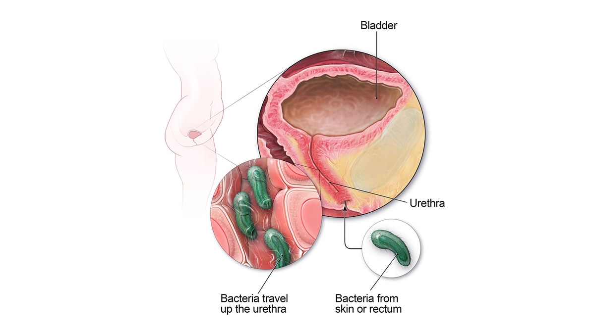 URINARY TRACT INFECTIONS