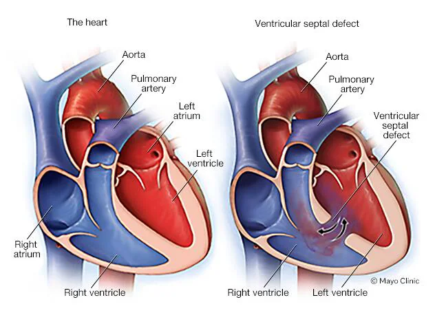 VENTRICULAR SEPTAL DEFECT EXPLAINED: A DETAILED CLINICAL GUIDE FOR PRACTITIONERS