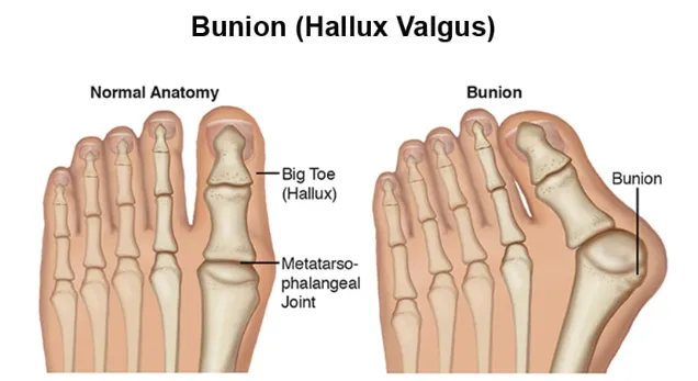 Bunion anatomy showing hallux valgus deformity and bone alignment